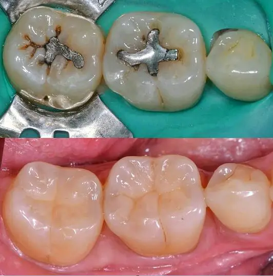 Εμφρακτικά υλικά - Αισθητική οδοντιατρική - Dental Kittas Ιωάννινα
