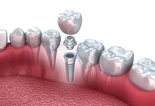 Εμφυτεύματα - Χειρουργική στόματος - Αισθητική οδοντιατρική - Dental Kittas Ιωάννινα
