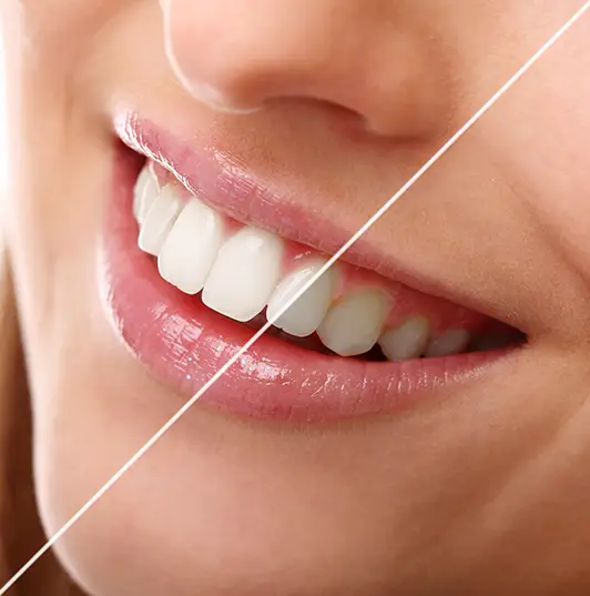 Λευκανση δοντιών - Αισθητική οδοντιατρική - Dental Kittas Ιωάννινα
