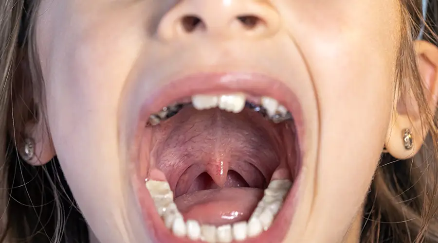 Καρκίνος του στόματος - Αρθρογραφία - Dental Kittas Ιωάννινα